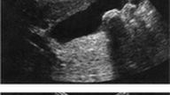 ULTRASOUND IMAGES CHOLELITHIASIS