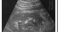 Ultrasound images of Focal pyelonephritis
