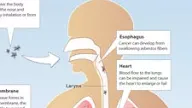 Asbestos Exposure