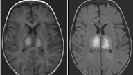 abnormal mri brain “Acute Necrotizing Encephalitis”