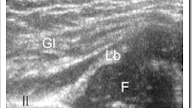 Ultrasound dysplasia of hip