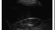 Ultrasound images of Renal tract stones