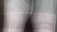 PHYSEAL BAR-CT