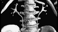 Shaded surface displays of ct scan abdominal