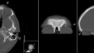 MRI - Metal Screening