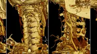 Vertebral Artery Dissection Collaterals