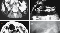 Superior Mesenteric Artery