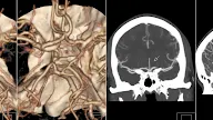 Anterior Cerebral Artery Trifurcation