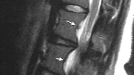 Vertebral Scalloping: Differential Diagnosis #26