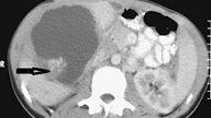 Hydatid cyst