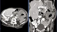Small Bowel Aneurysmal Dilatation Differential Diagnosis