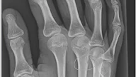 Fibrous Cortical Defect Metacarpal