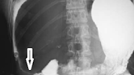 Laparoscopic Cholecystectomy
