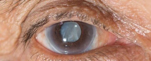 Nutrition and Supplements for cataract