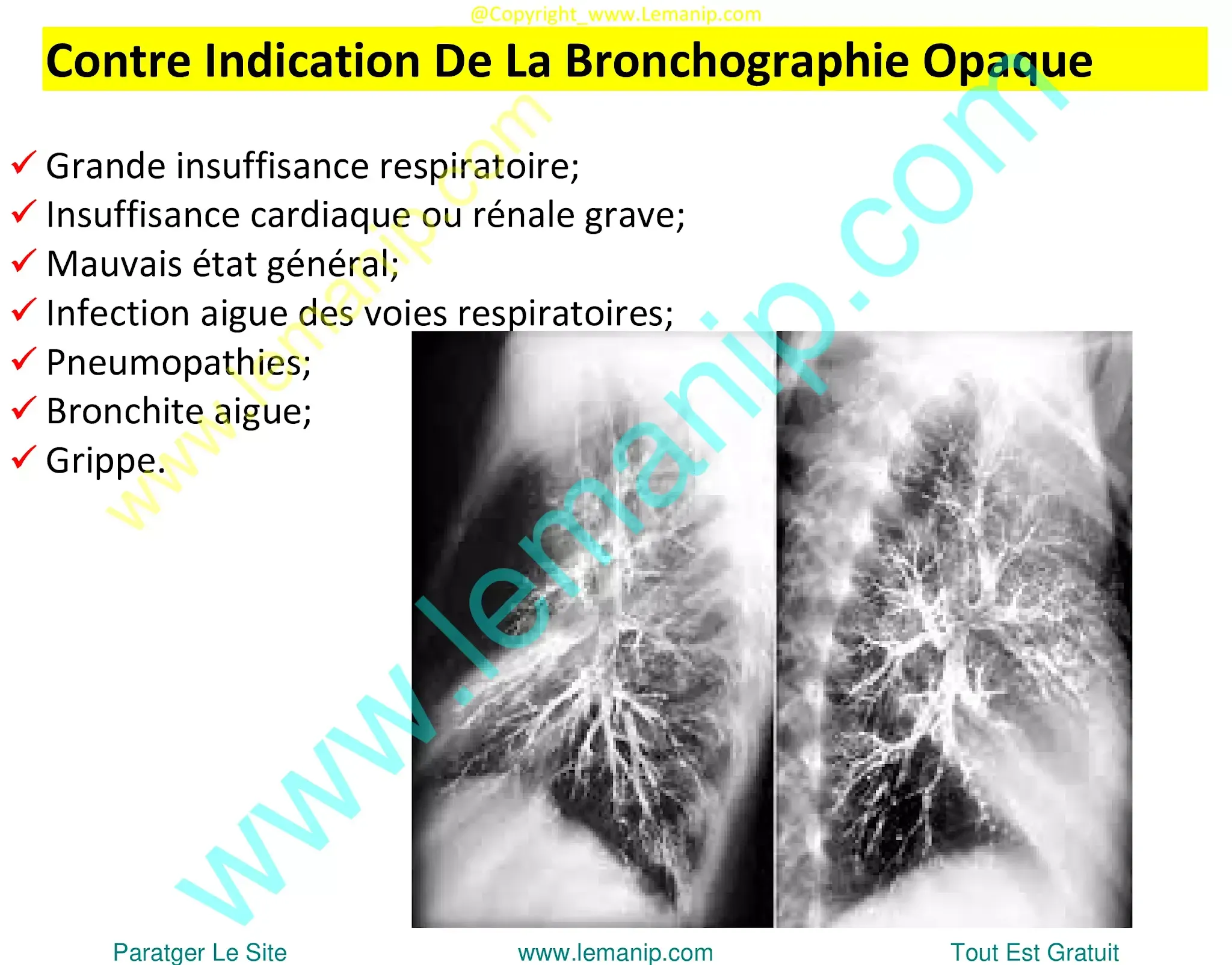 bronchoalveolar ca,lung lavage for copd,whole lung lavage,lung lavage,opdivo lung,restrictive airway disease,small airway disease,inflated lungs,hyperexpanded lungs,enlarged lungs