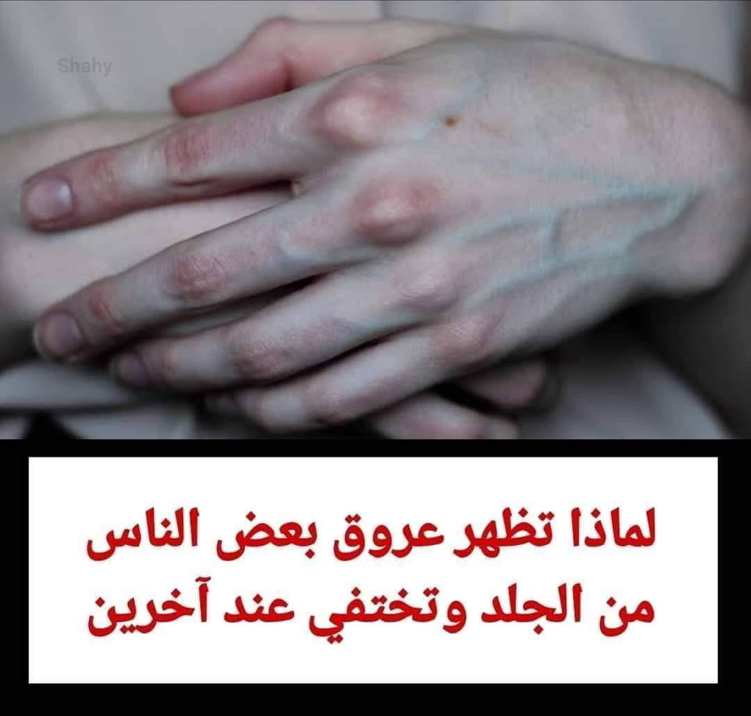 لماذا تظهر عروق بعض الناس من الجلد