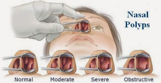 WHAT IS POLYPUS IN NOSE?MAIN CAUSES, REASONS, ARE NASAL POLYPUS SERIOUS? WHAT HAPPENS IF NASAL POLYPUS GO UNTREATED? NASAL POLYPUS SURGERY,  DIAGNOSIS, NASA TREATMENT