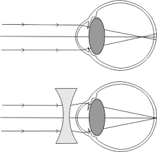 निकट दृष्टि दोष और दूर दृष्टि दोष में क्या अंतर है