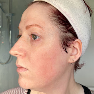 Day 5 after SkinPen