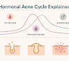 The Ultimate Guide to Hormonal Acne: Science-Backed Solutions + Product Recs