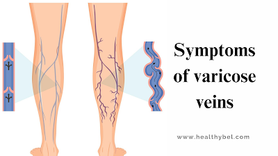 Say Goodbye to Varicose Veins: Effective Remedies for Healthy Legs
