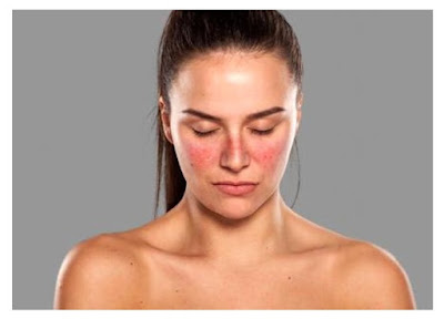 Understand Lupus (SLE) an inflammatory disease that has no cure yet