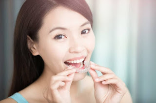 Quy trình niềng răng đạt chuẩn-1