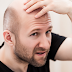 Causes and medicines for going bald