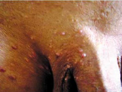 Hình ảnh nốt sùi mào gà giai đoạn đầu xung quanh bộ phận sinh dục nam
