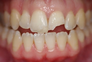 Quy trình trám răng thẩm mỹ-2