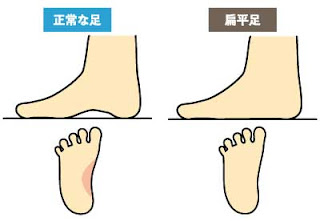正常な足と扁平足の足を比較したイラストで、扁平足の人は土踏まず部分が地面についている。