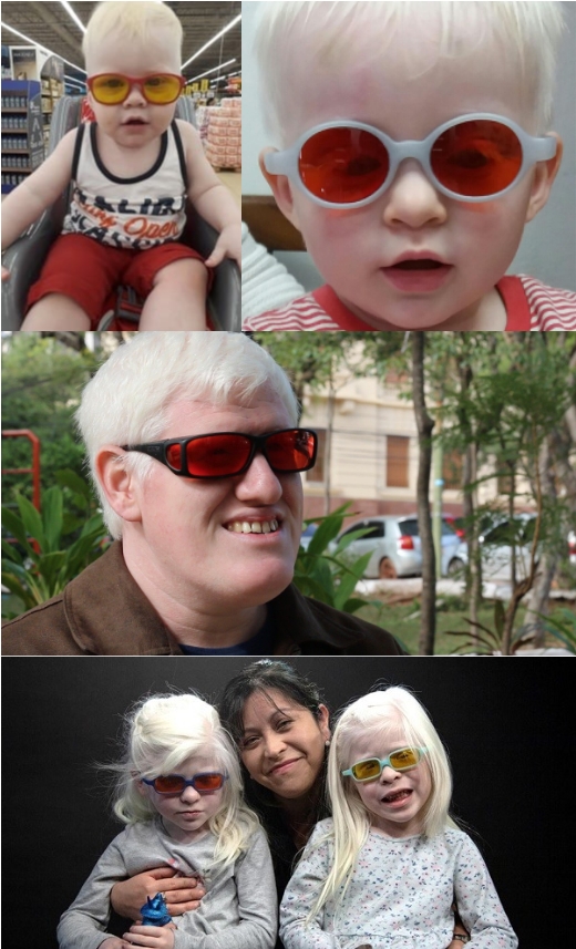 Lente Para Personas Con Albinismo