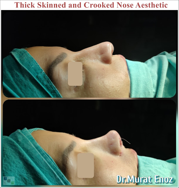 Thick Skinned and Crooked Nose Aesthetic - Natural Rhinoplasty