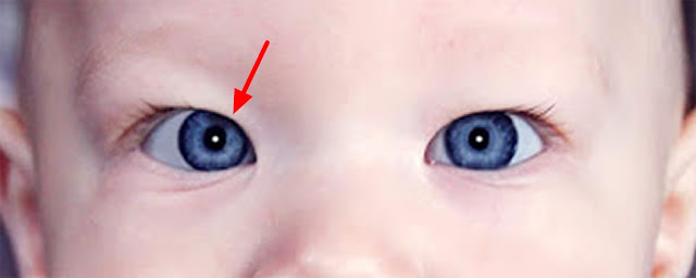 STRABISMUS CAUSES AND ITS TREATMENT