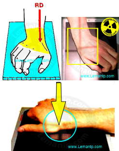 scaphoid bone in hand,scaphoid fracture hand,scaphoid fracture management,scaphoid injury,scaphoid fracture orthobullets,best brace for scaphoid fracture,scaphoid pain treatment,scaphoid pain relief,scaphoid fracture splint type,scaphoid brace