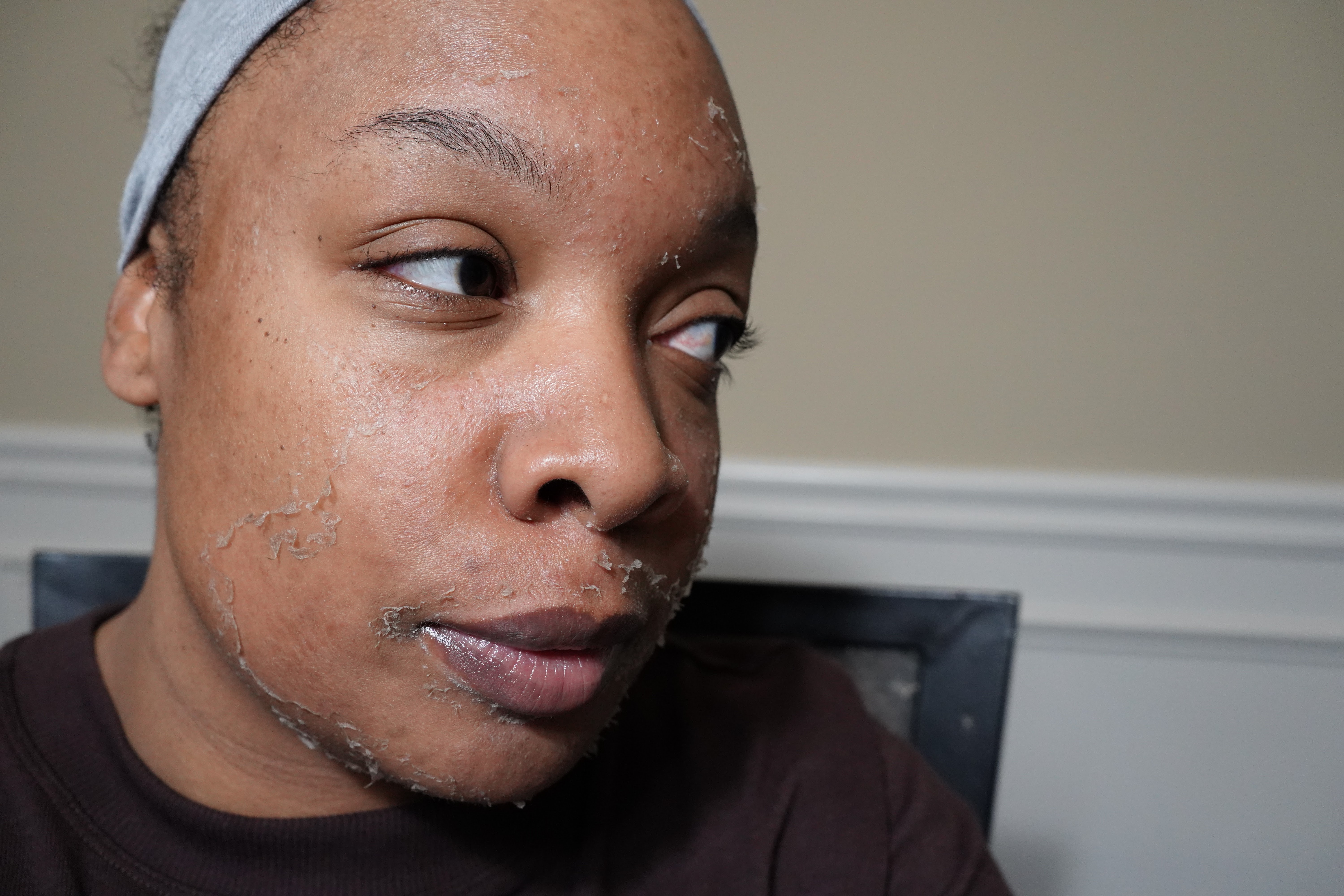 Video: Are Chemical Peels Worth it?  My First Experience