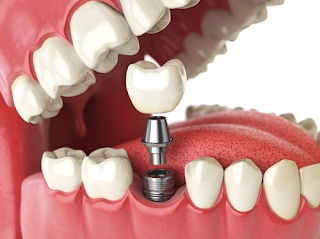 Quy trình cấy ghép răng implant đạt chuẩn-1