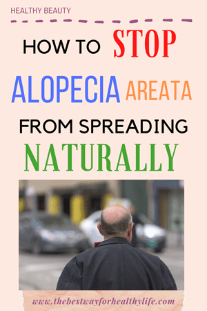 How To Stop Alopecia Areata From Spreading Naturally