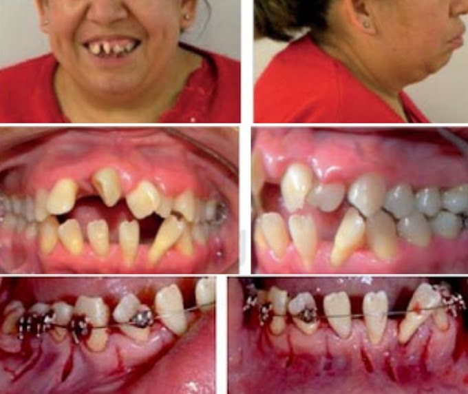 PDF: Tratamiento de ortodoncia acelerada en paciente con tejidos periodontales reducidos. Caso clínico
