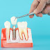 Bảng giá trồng răng implant mới nhất