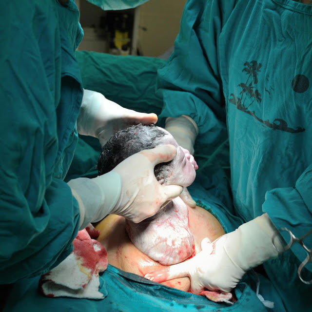 الولادة القيصرية سهلة جدا,العملية القيصرية بالصور,كم تستغرق العملية القيصرية,تجارب الولادة القيصرية,فوائد الولادة القيصرية,فيديو الولادة القيصرية كامل,كم تستغرق العملية القيصرية الثالثة,قبل العملية القيصرية بيوم