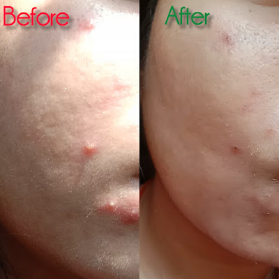 Adapalene and clindamycin gel results