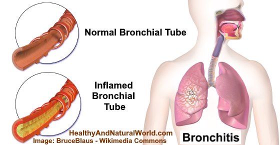 WHAT IS BRONCHIAL ASTHMA AND ITS TREATMENT