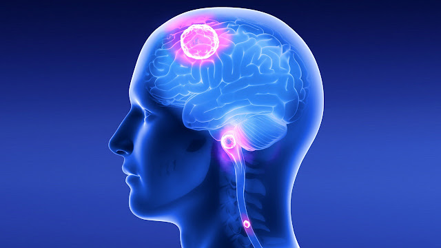 Pathophysiology of Astrocytoma