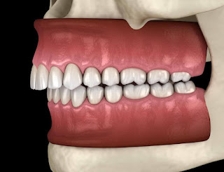 Niềng răng xong bị hở lợi - Cần khắc phục ngay-2
