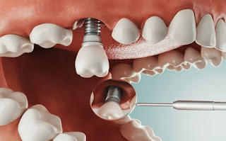 Chăm sóc răng sau khi cắm implant như thế nào-2