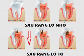 Trám răng sâu giá bao nhiêu-1