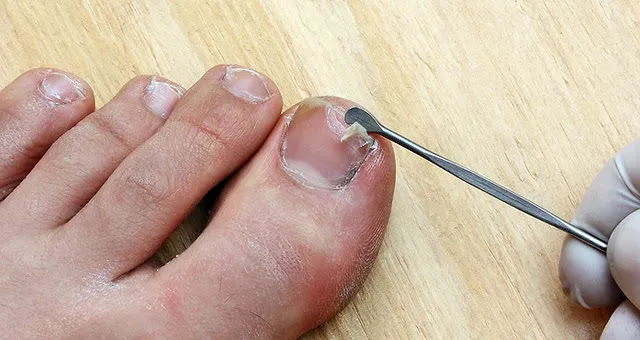 Ingrown Toenails