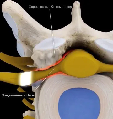костные шпоры тела позвонка).