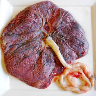 Whole Placenta with umbilical cord attached